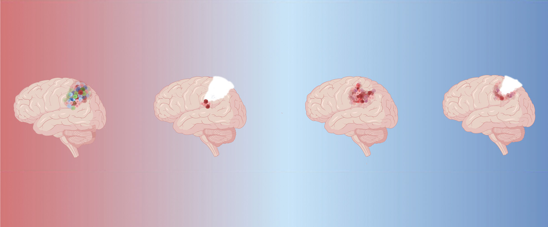 Unique evolutionary pathways during recurrence of different gliomas