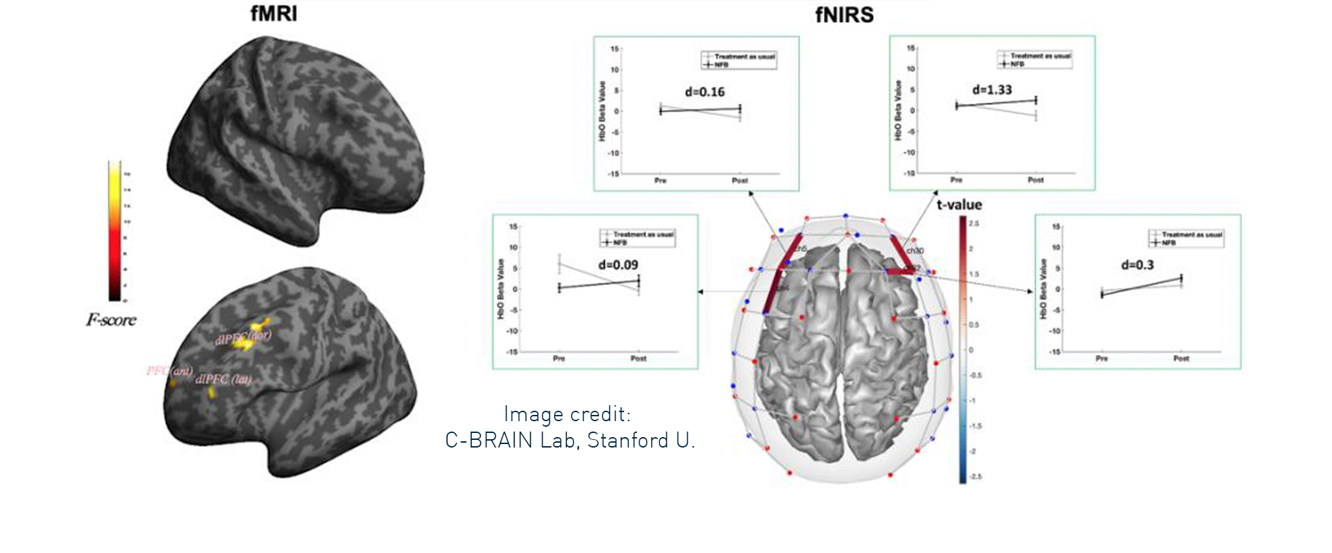 Revolutionizing ADHD Treatment Through Neuromonitoring Guided Working Memory Interventions